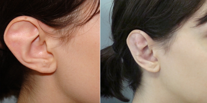 Otoplastika, nakon 7  dana